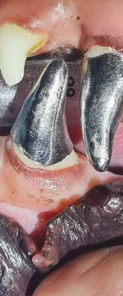 Fracturas dentales