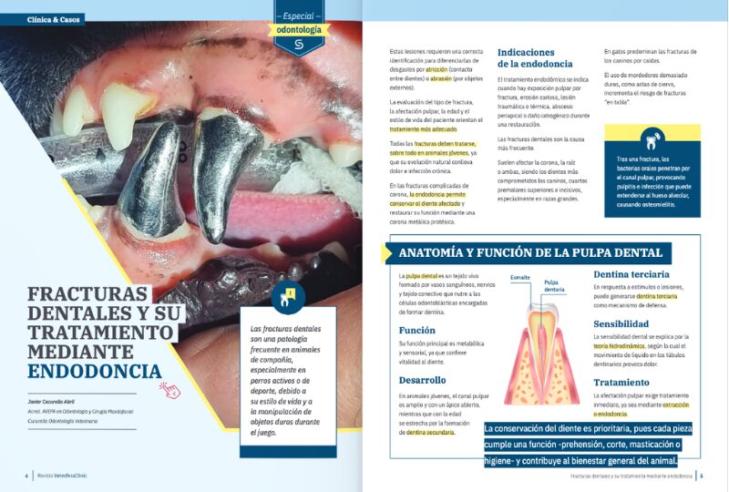 Fracturas dentales y su tratamiento mediante endodoncia